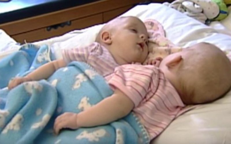 Вот как выросли сиамские близнецы, которых разделили еще в младенчестве