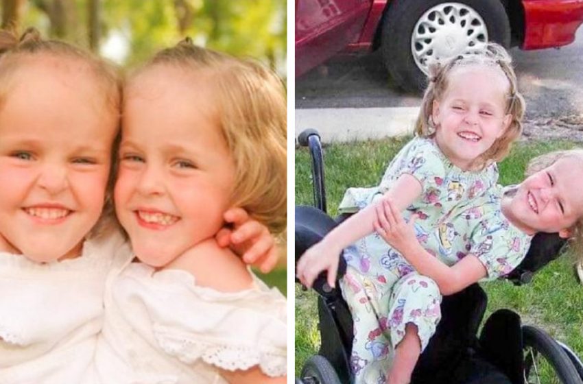 Comment vivent aujourd’hui ces jumeaux siamois, qui se sont séparés à 4 ans !